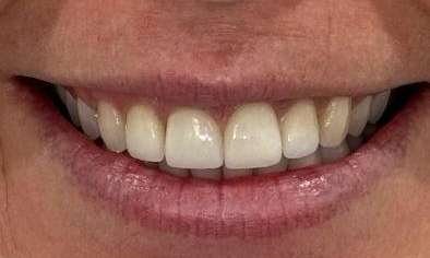 Portside Dental Whitening Veneers Recontouring After 2
