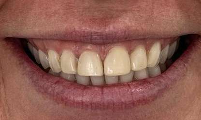 Portside Dental Whitening Veneers Recontouring Before 2