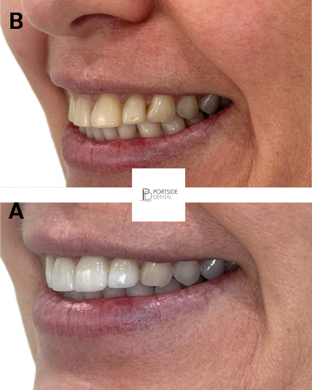 Veneers-and-whitening-side-view--B-&-A