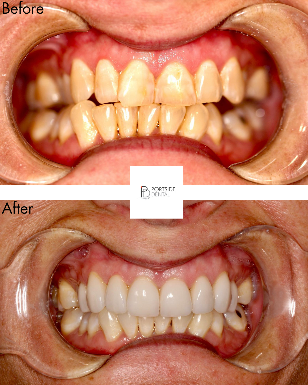 Whitening and 8 veneers