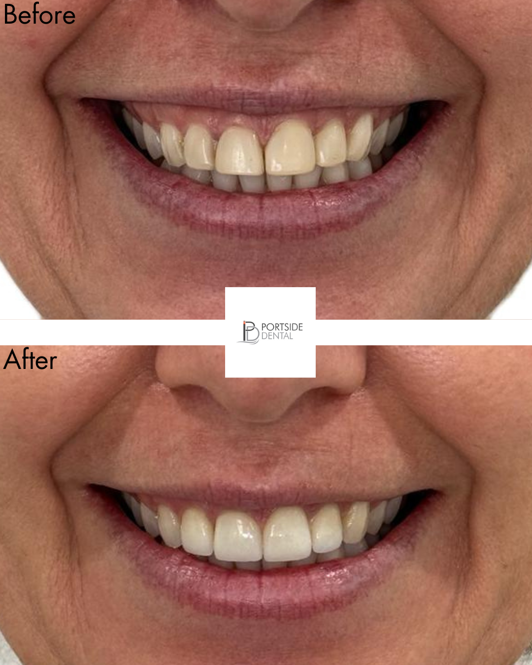 Whitening and 4 veneers