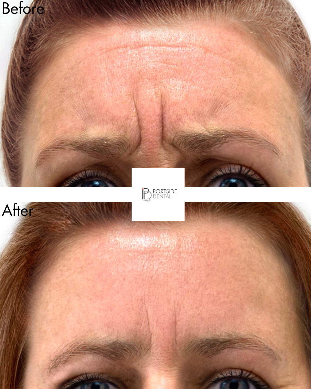 Anti Wrinkle - Raising Eyebrows