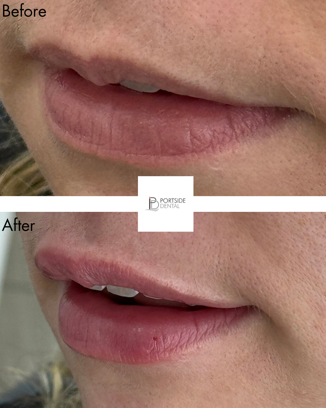 1Ml Lip Filler