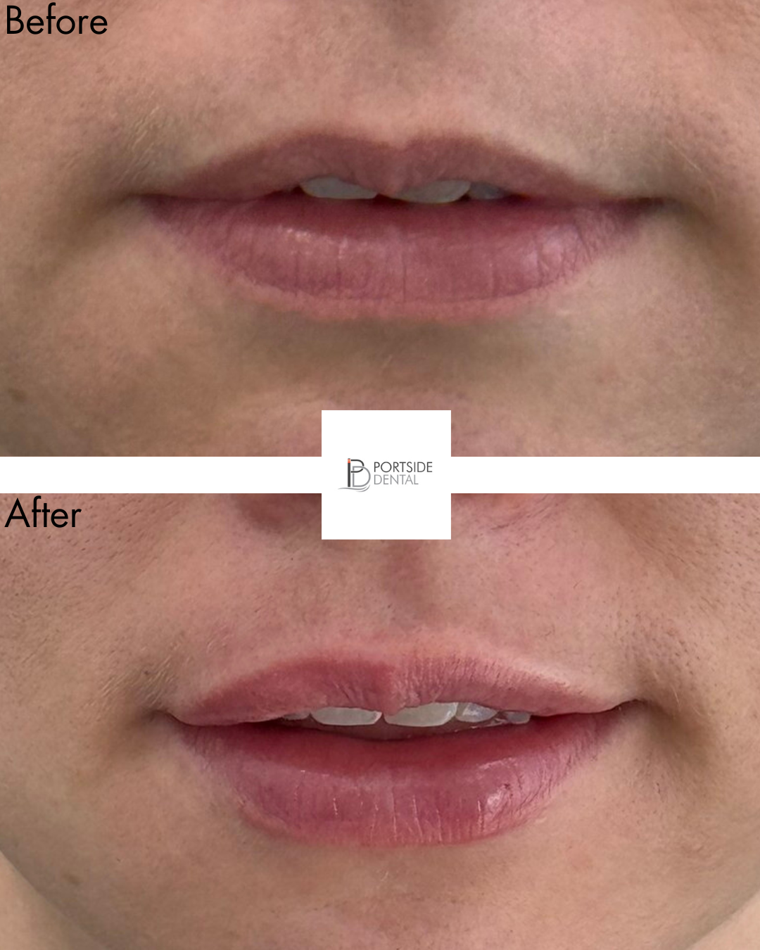 1 Ml Lip Filler